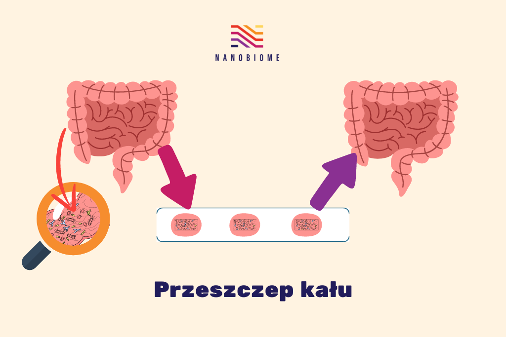 grafika ilustruje przeszczep mikrobioty jelitowej. W jelicie znajdują się mikroorganizmy. Pula mikrobów zostaje przeniesiona z jednego srodowiska jelit do innego, aby wzbogacić to drugie. NANOBIOME